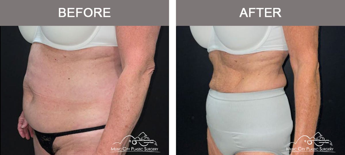 Weight Loss Injections Before & After Gallery - Patient 396510 - Image 4