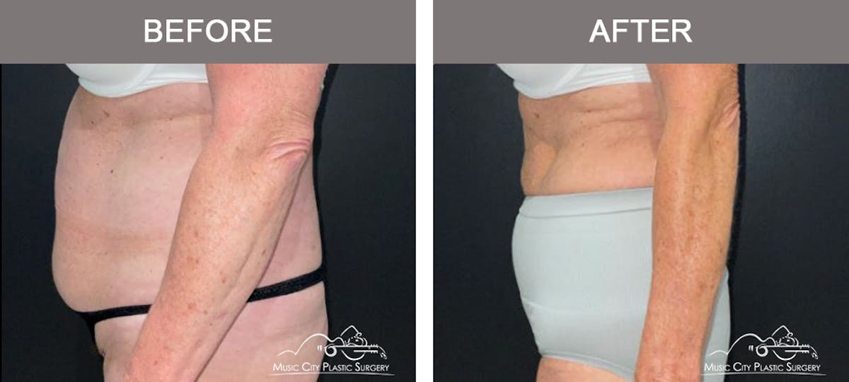 Weight Loss Injections Before & After Gallery - Patient 396510 - Image 5