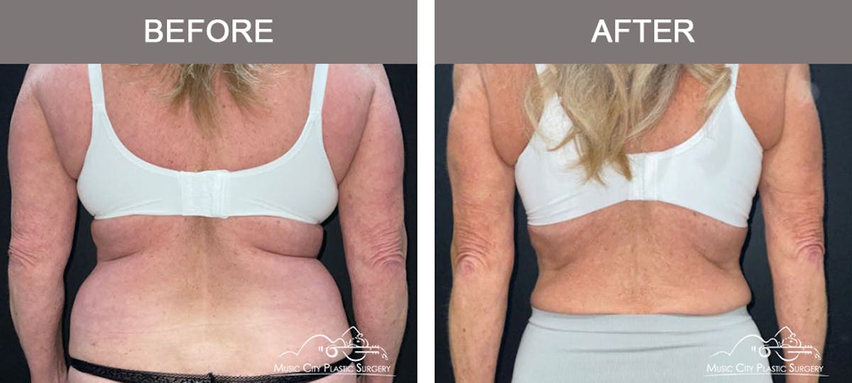 Semaglutide Before & After Gallery - Patient 396510 - Image 6