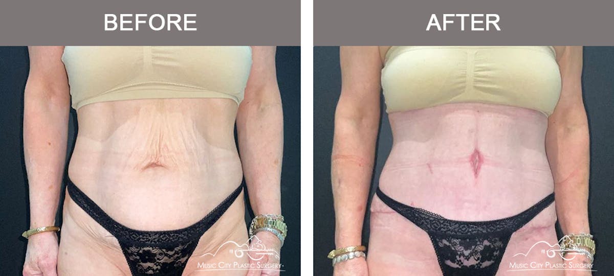 Liposuction Before & After Gallery - Patient 360697 - Image 1