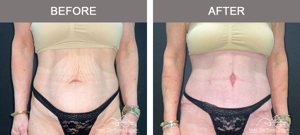 Tummy Tuck (Abdominoplasty) Before & After Gallery - Patient 122218 - Image 1