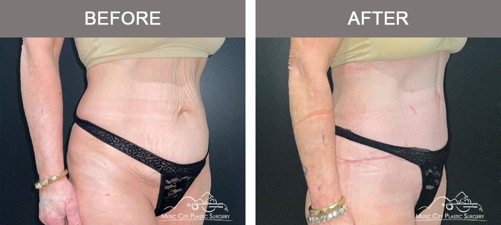 Tummy Tuck (Abdominoplasty) Before & After Gallery - Patient 122218 - Image 2