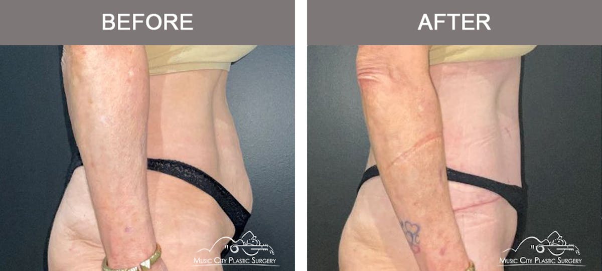 Liposuction Before & After Gallery - Patient 360697 - Image 3