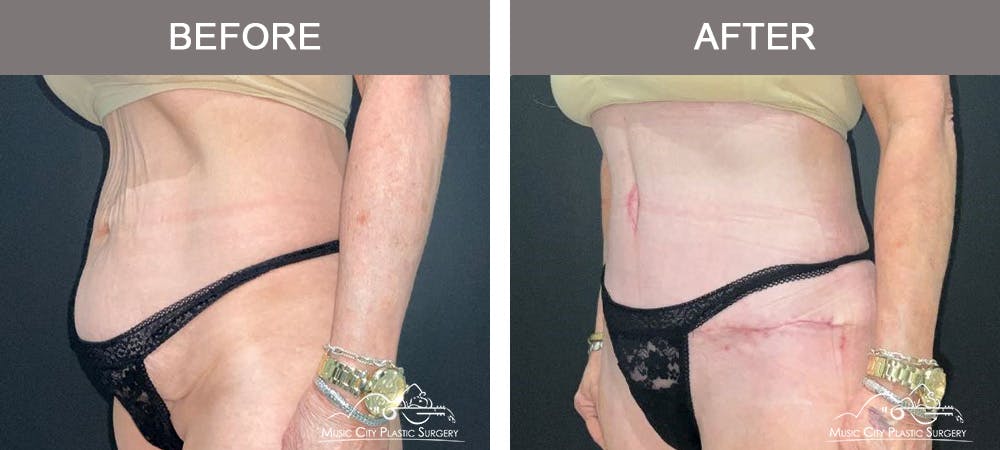 Tummy Tuck (Abdominoplasty) Before & After Gallery - Patient 122218 - Image 4
