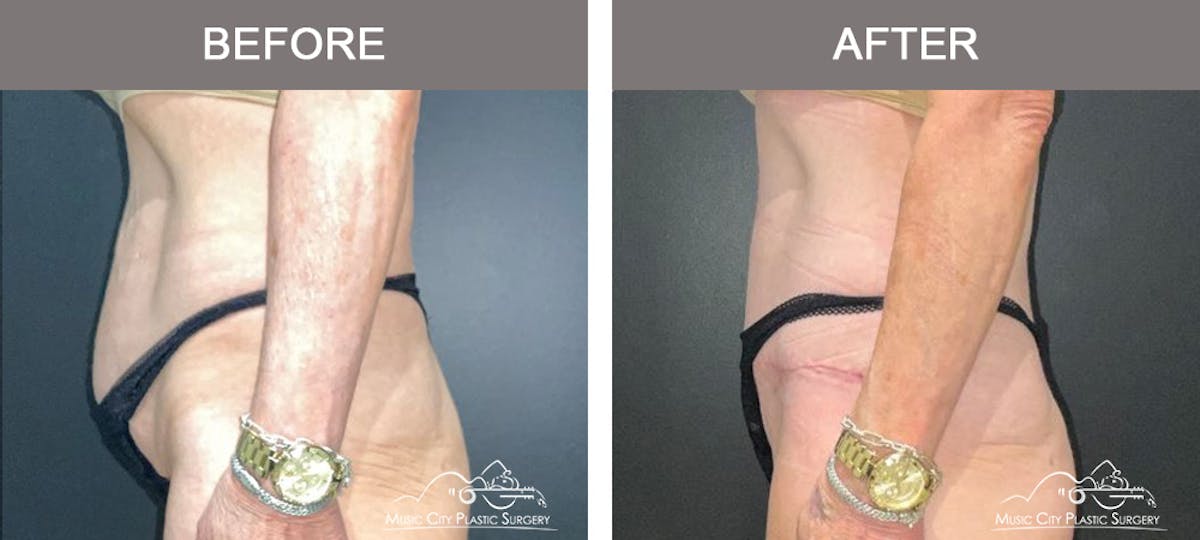 Liposuction Before & After Gallery - Patient 360697 - Image 5