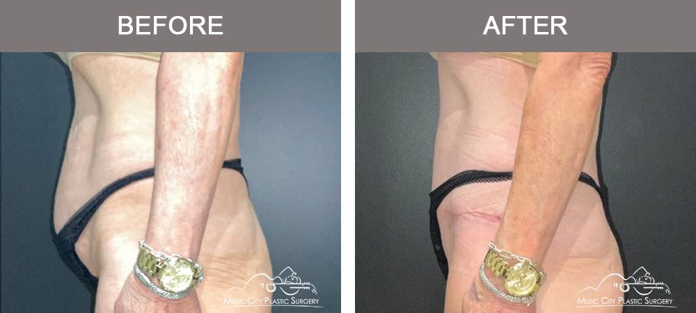 Tummy Tuck (Abdominoplasty) Before & After Gallery - Patient 122218 - Image 5