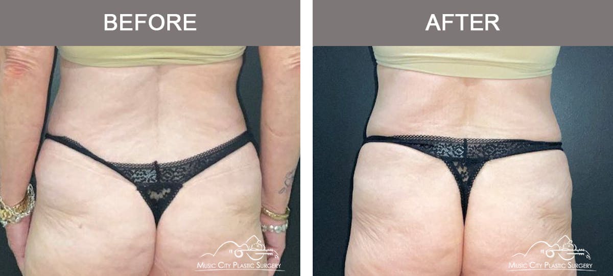 Liposuction Before & After Gallery - Patient 360697 - Image 6