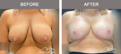 Breast Lift Before & After Gallery - Patient 177053 - Image 1