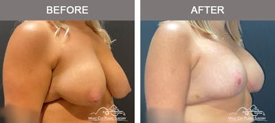 Breast Lift Before & After Gallery - Patient 177053 - Image 2