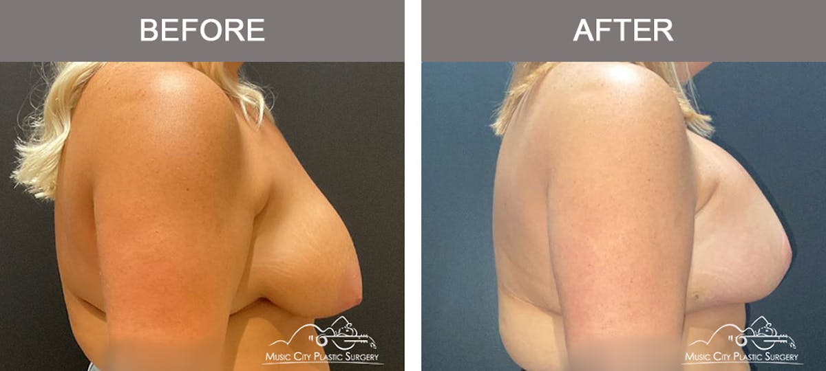 Breast Lift Before & After Gallery - Patient 177053 - Image 3
