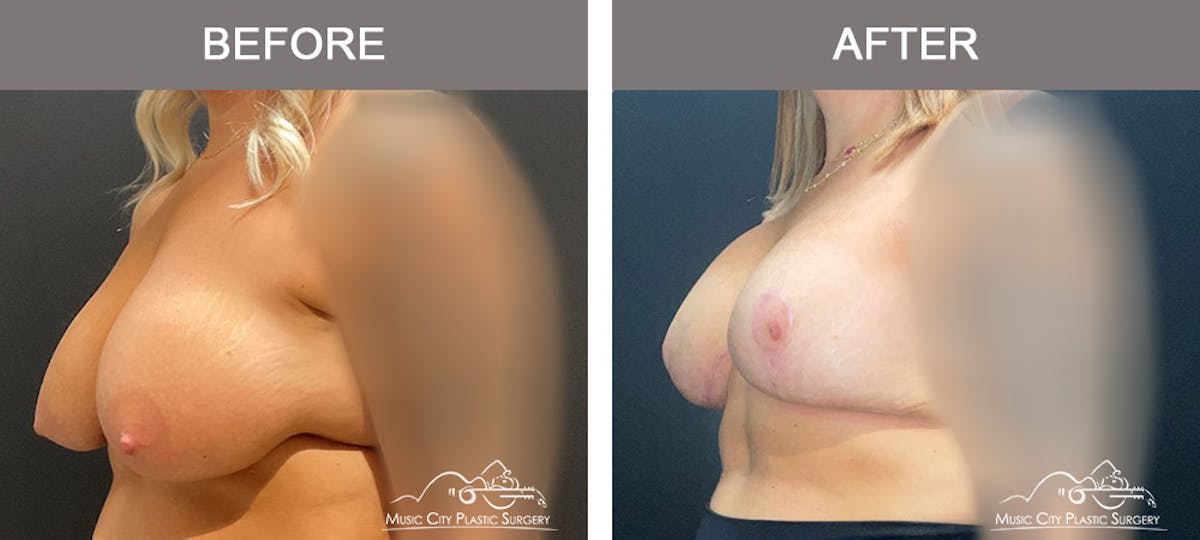 Breast Augmentation Before & After Gallery - Patient 104965 - Image 4