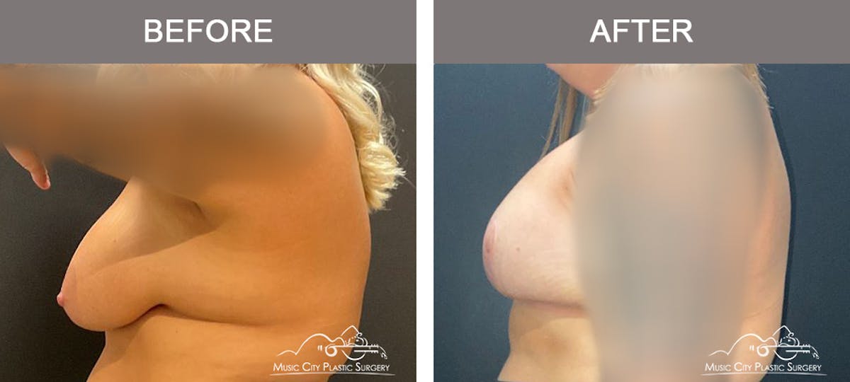 Breast Lift Before & After Gallery - Patient 177053 - Image 5