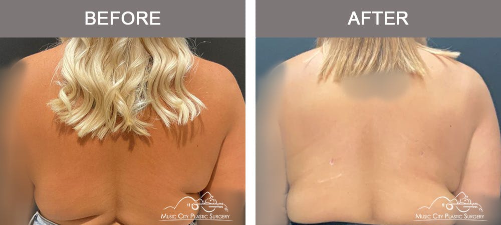 Breast Lift Before & After Gallery - Patient 177053 - Image 6