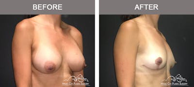 Breast Augmentation Before & After Gallery - Patient 307754 - Image 2