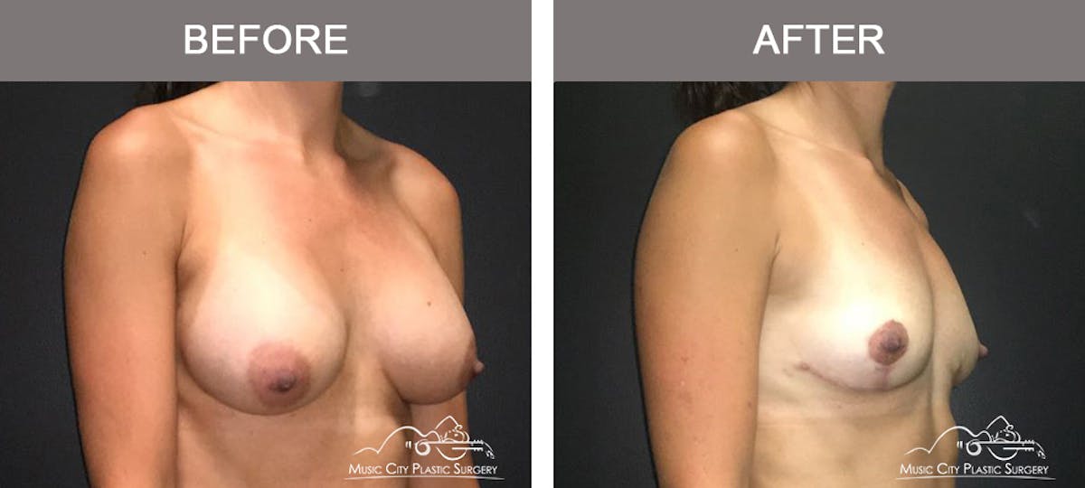 Breast Lift Before & After Gallery - Patient 262099 - Image 2