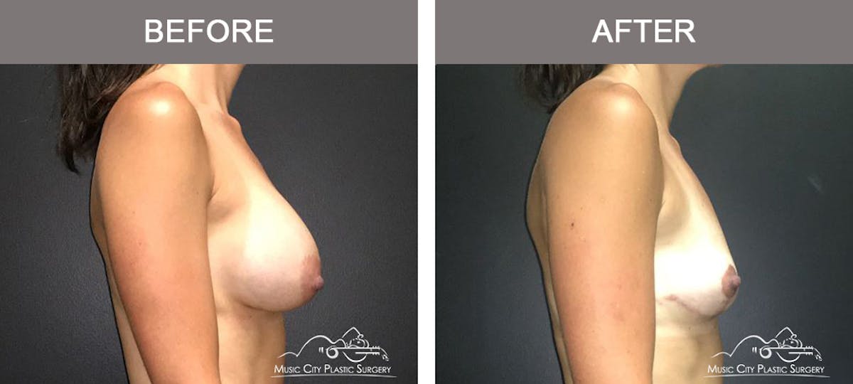 Breast Augmentation Before & After Gallery - Patient 307754 - Image 3