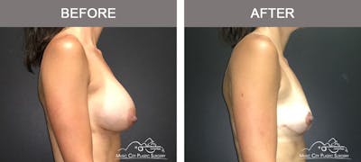 Breast Augmentation Before & After Gallery - Patient 307754 - Image 3