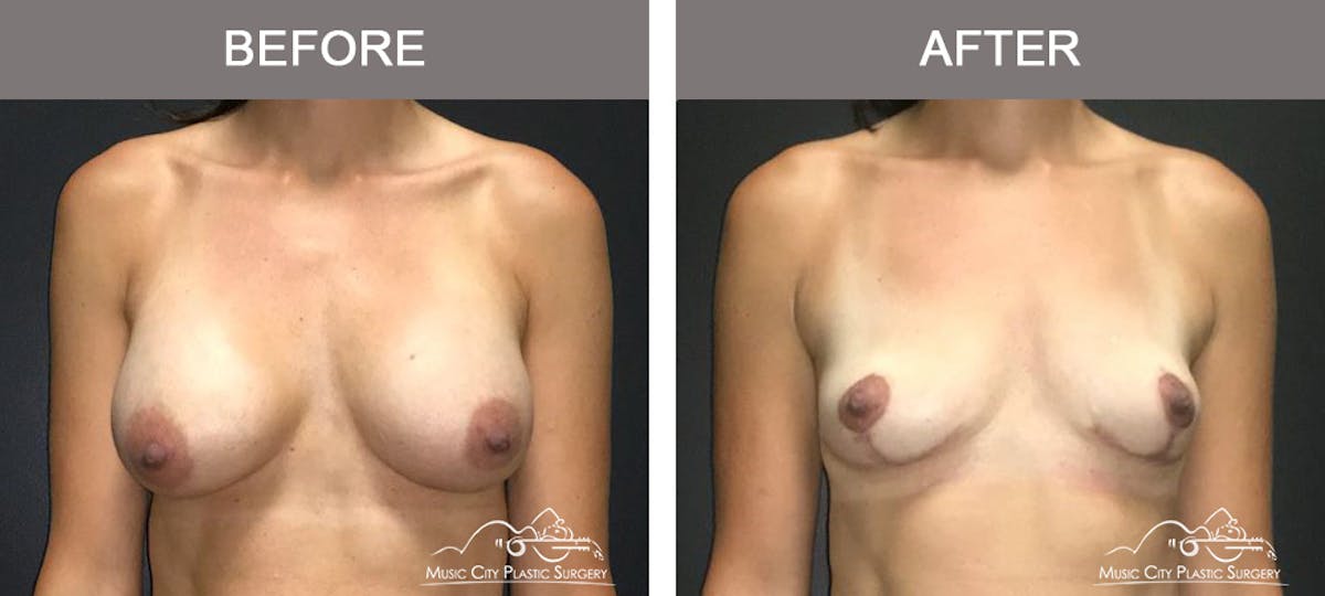 Breast Lift Before & After Gallery - Patient 262099 - Image 1