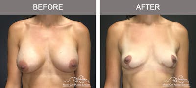 Breast Augmentation Before & After Gallery - Patient 307754 - Image 1