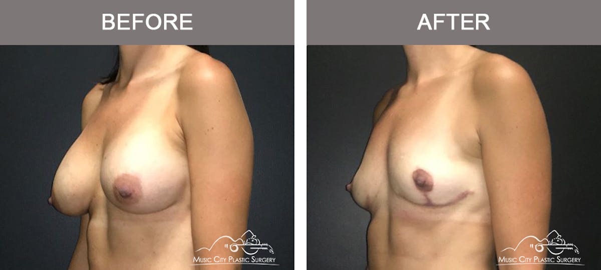 Breast Augmentation Before & After Gallery - Patient 307754 - Image 4