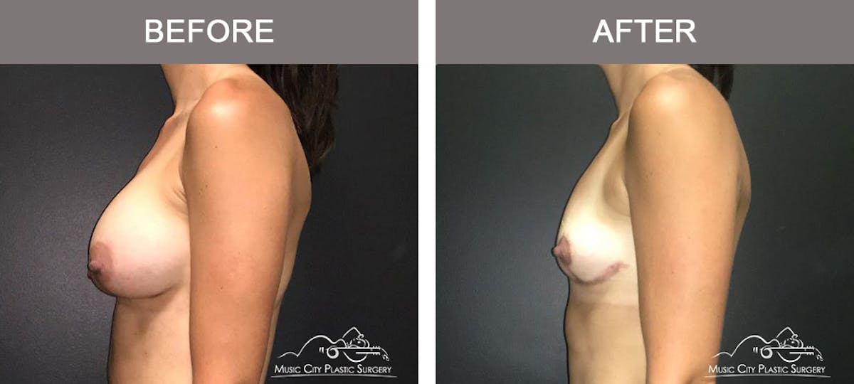 Breast Lift Before & After Gallery - Patient 262099 - Image 5