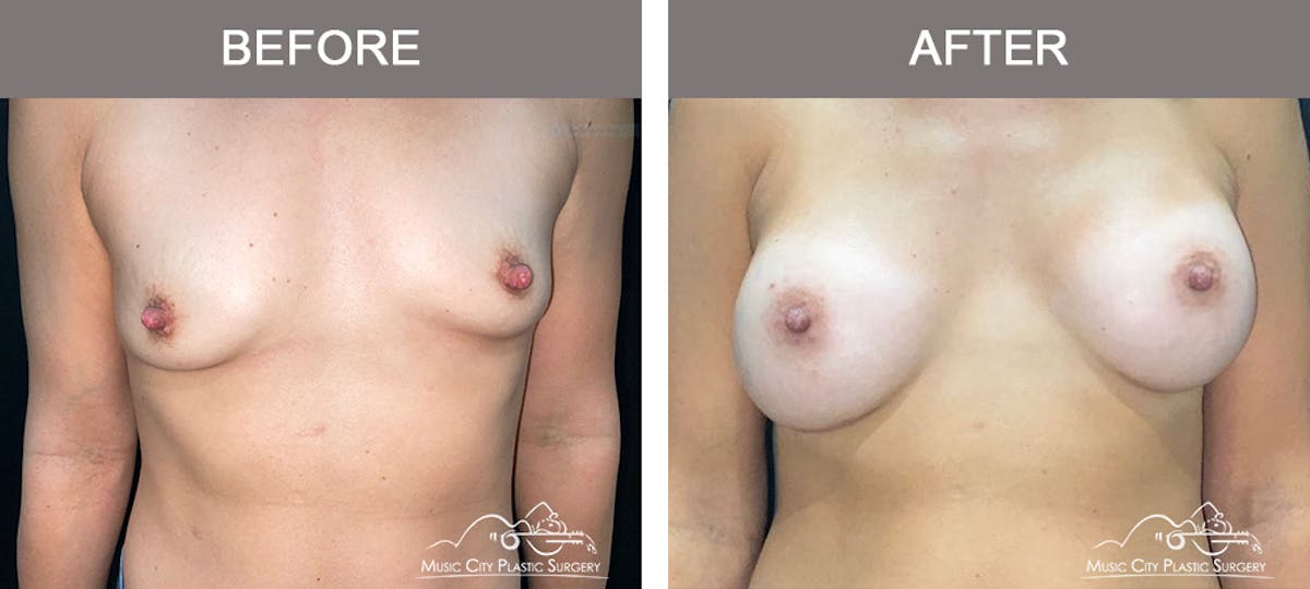 Breast Augmentation Before & After Gallery - Patient 158234 - Image 1
