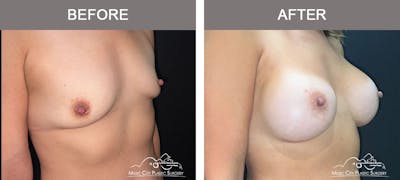Breast Augmentation Before & After Gallery - Patient 158234 - Image 2
