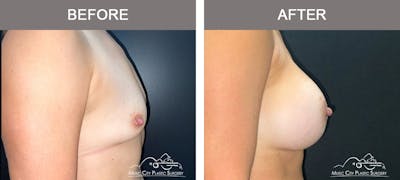 Breast Augmentation Before & After Gallery - Patient 158234 - Image 3