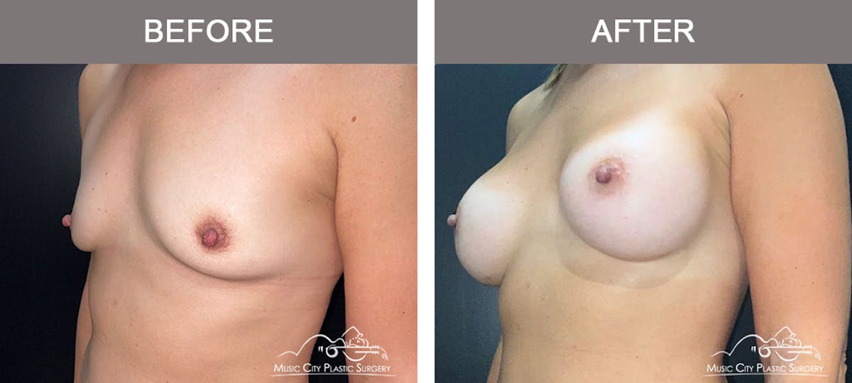 Breast Augmentation Before & After Gallery - Patient 158234 - Image 4