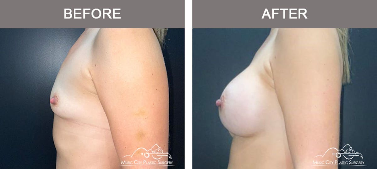 Breast Augmentation Before & After Gallery - Patient 158234 - Image 5