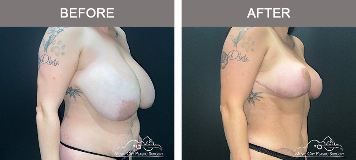 Liposuction Before & After Gallery - Patient 211453 - Image 2