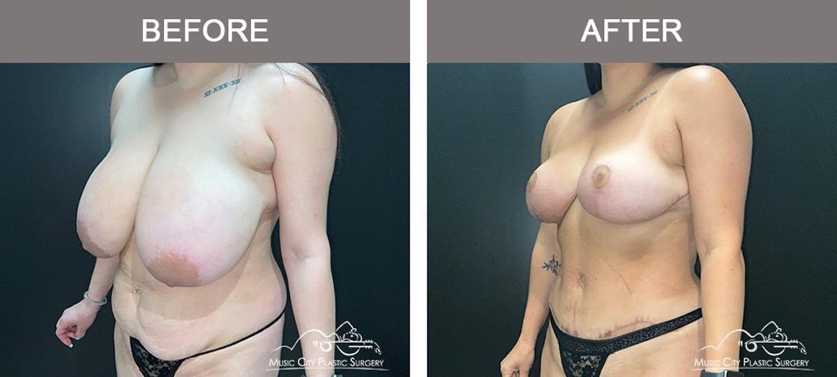 Breast Reduction Before & After Gallery - Patient 468965 - Image 4