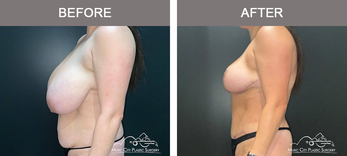 Abdominoplasty Before & After Gallery - Patient 485759 - Image 5