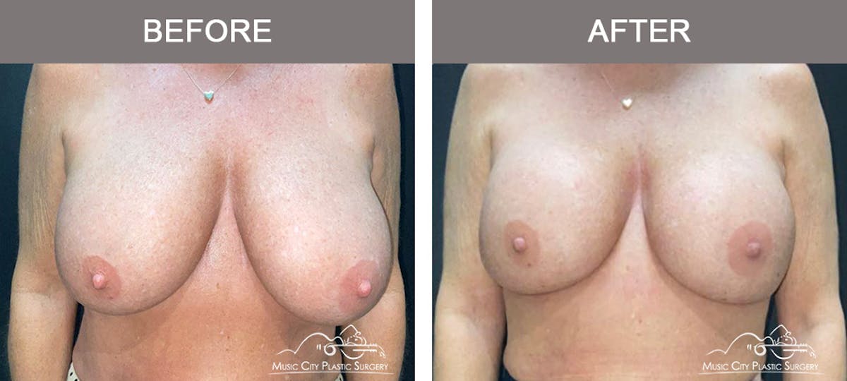 Implant Exchange Before & After Gallery - Patient 164645 - Image 1