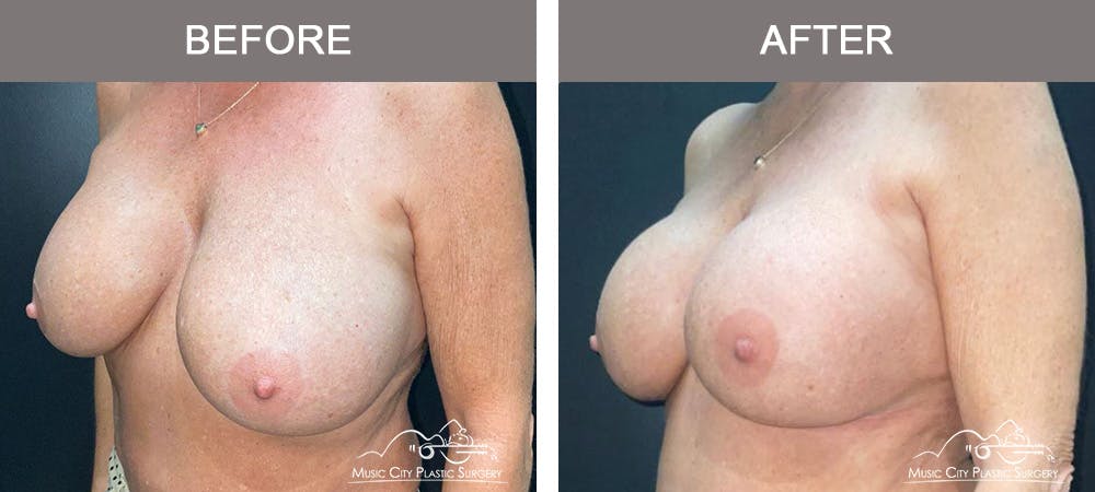 Implant Exchange Before & After Gallery - Patient 164645 - Image 4