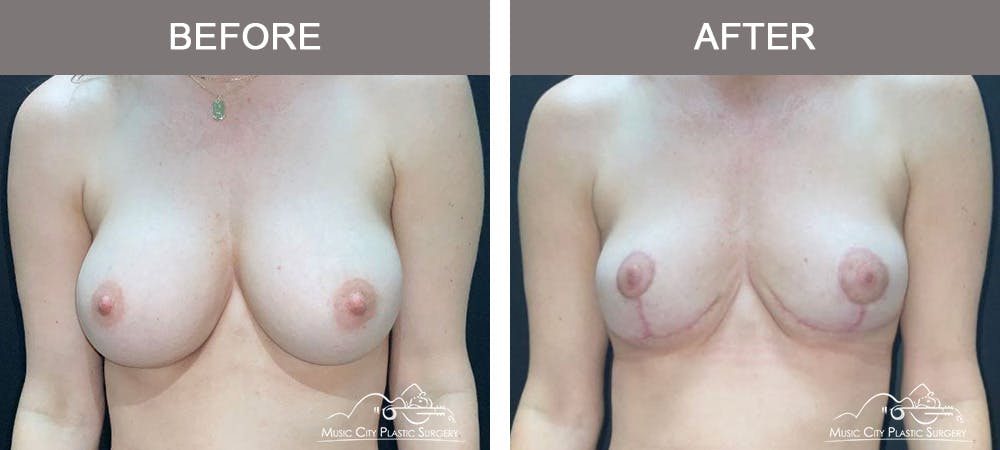 Capsulectomy Before & After Gallery - Patient 638356 - Image 1