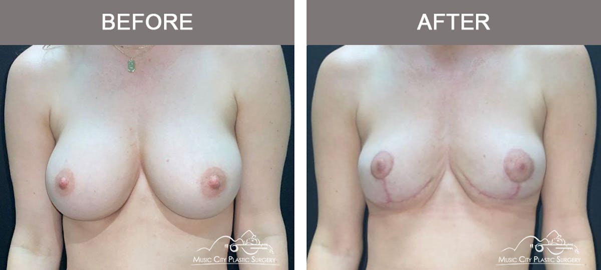 Capsulectomy Before & After Gallery - Patient 638356 - Image 1