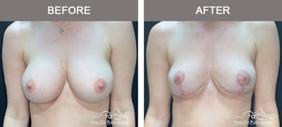 Capsulectomy Before & After Gallery - Patient 638356 - Image 1