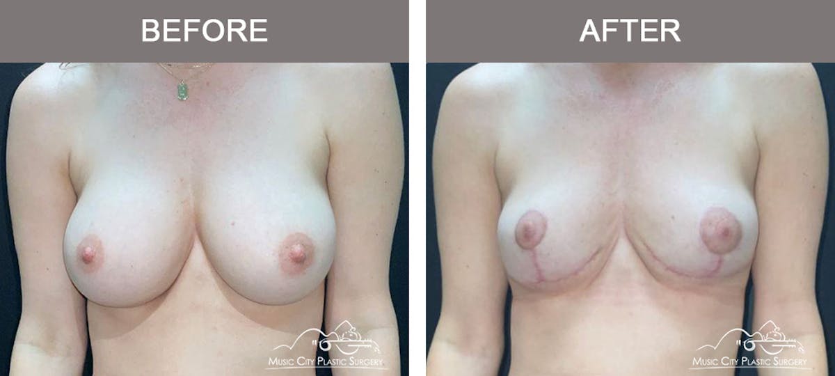 Capsulectomy Before & After Gallery - Patient 638356 - Image 1