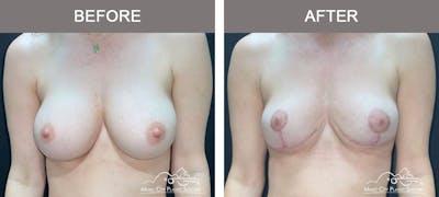 Breast Lift Before & After Gallery - Patient 260574 - Image 1