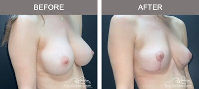 Breast Lift Before & After Gallery - Patient 260574 - Image 2