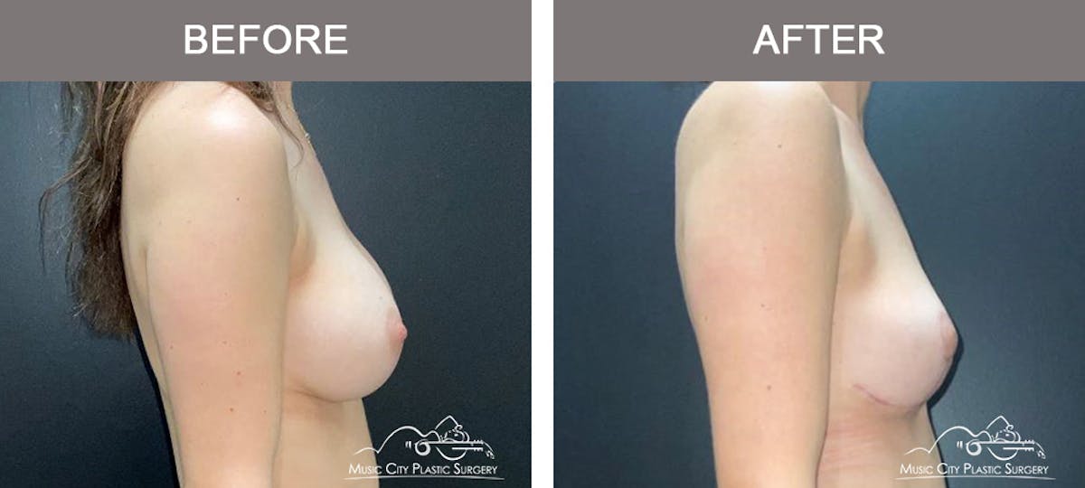 Breast Lift Before & After Gallery - Patient 260574 - Image 3