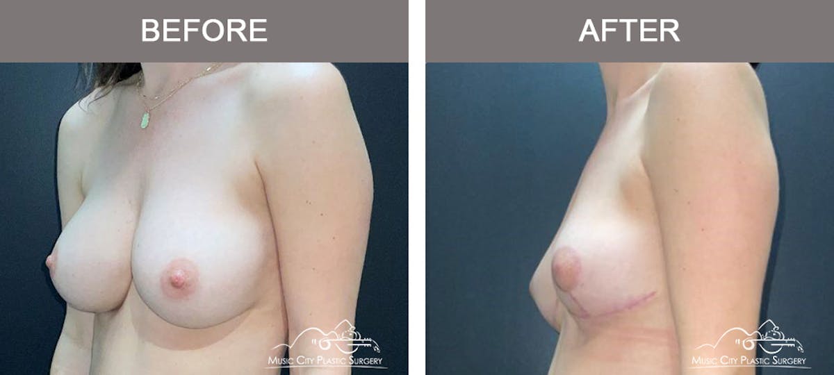 Breast Lift Before & After Gallery - Patient 260574 - Image 4