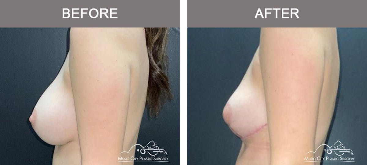 Capsulectomy Before & After Gallery - Patient 638356 - Image 5