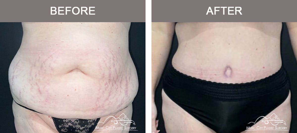 Abdominoplasty Before & After Gallery - Patient 144031 - Image 1