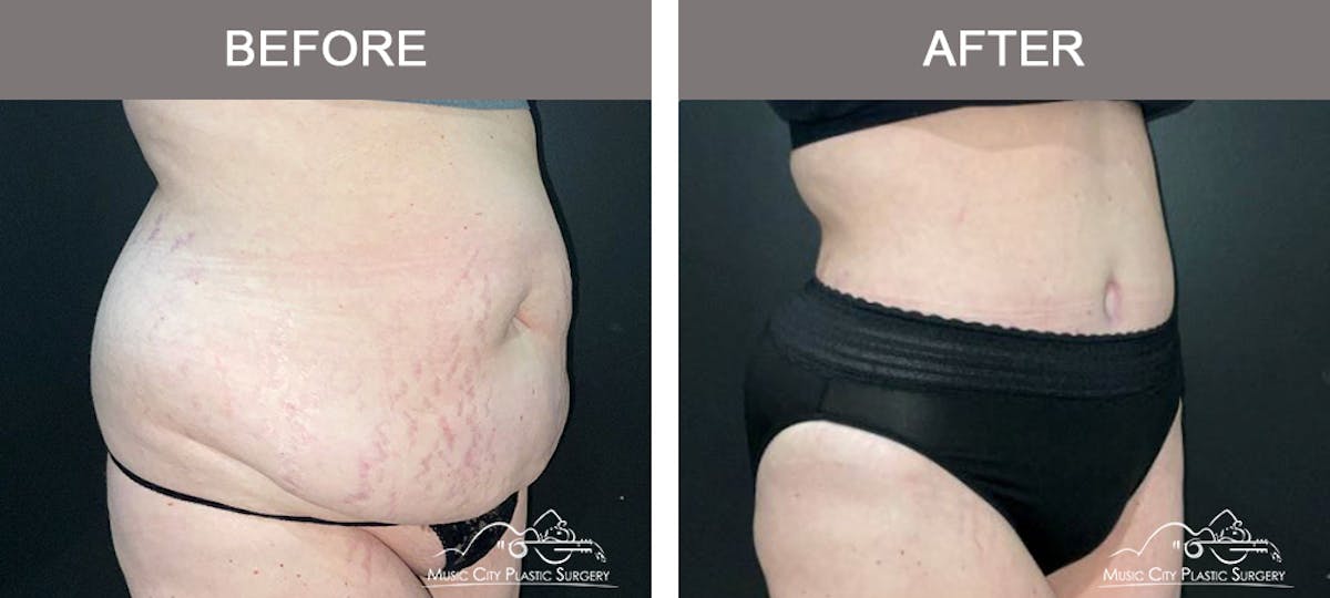 Abdominoplasty Before & After Gallery - Patient 144031 - Image 2