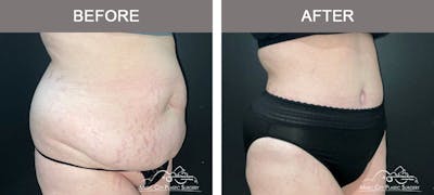 Abdominoplasty Before & After Gallery - Patient 144031 - Image 2