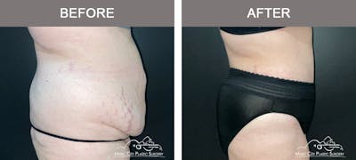 Abdominoplasty Before & After Gallery - Patient 144031 - Image 3