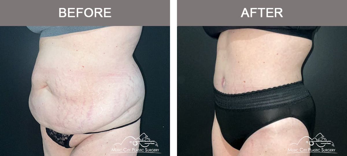 Abdominoplasty Before & After Gallery - Patient 144031 - Image 4