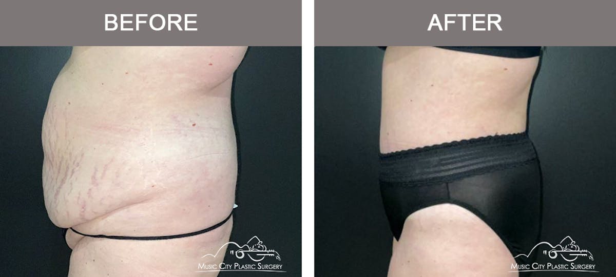 Liposuction Before & After Gallery - Patient 426681 - Image 5